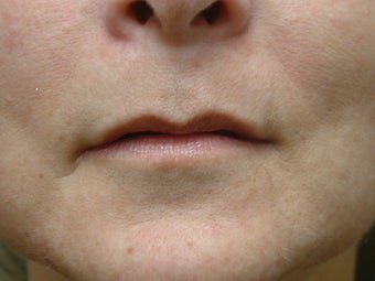 Lip Augmentation