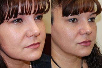 Lip Augmentation with Silikon-1000
