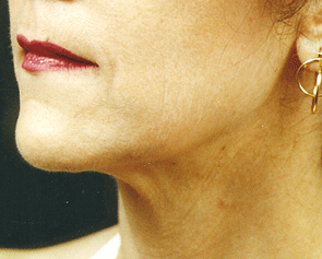 Lip Enhancement