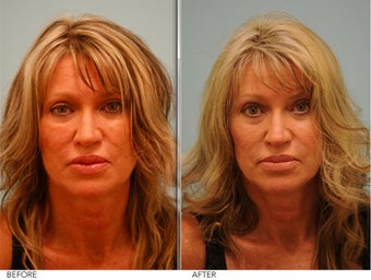 Lip Reduction for Correction of Silicone