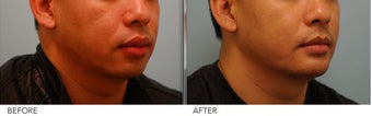 Lip Reduction for Correction of Silicone