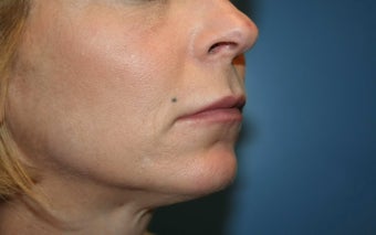 Lip Augmentation