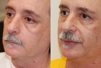 Lip Augmentation with Silikon-1000.