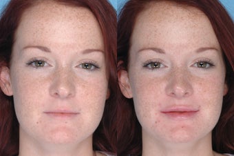 Juvederm Lip Augmentation