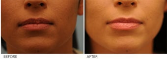 Upper Lip Reduction for Traumatic Lip Deformity