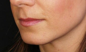 Lip augmentation