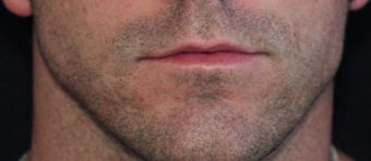 Male lip augmentation