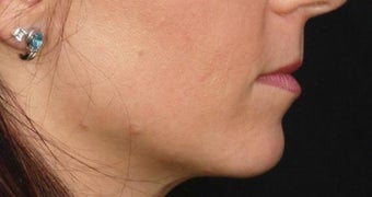 Lip Augmentation