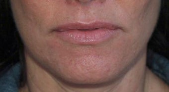 Lip Augmentation