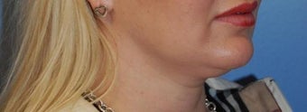 Lip Augmentation