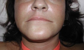 lip augmentation