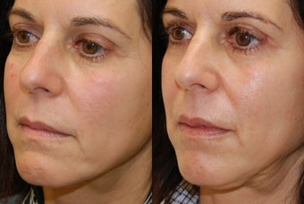 Lip Augmentation with Silikon-1000