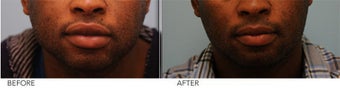 African American Lip Reduction