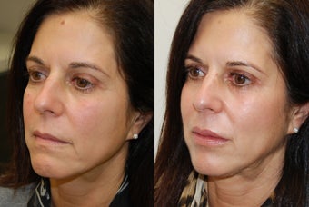 Lip Augmentation with Silikon-1000. 2 treatments.