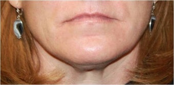 Lip augmentation - juvederm