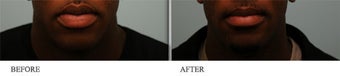 Upper and Lower Lip Reduction