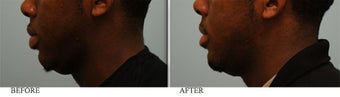 African American Lip Reduction