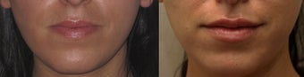 Lip Enhancement