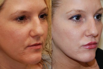 Lip Augmentation with Silikon-1000. 2 treatments.