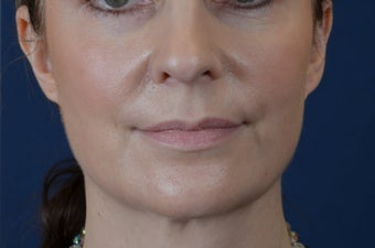 Lip Augmentation with Filler