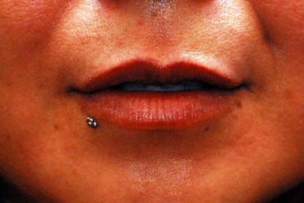 Lip Augmentation
