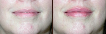 Lip augmentation
