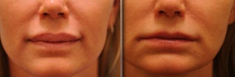 Upper and Lower Lip Reduction