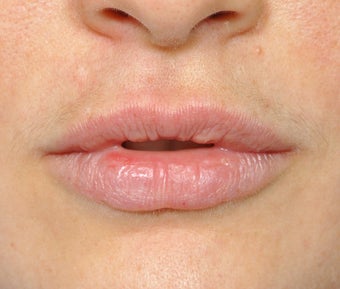 Lip Augmentation