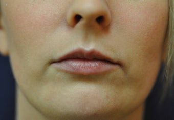Lip Augmentation with Filler