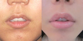 Non Surgical Lip Enhancement