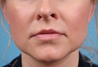 Lip Augmentation