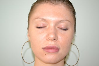 Lip Implant