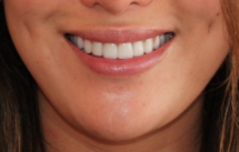 Lip Implant and Dimple Creation