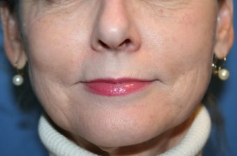 Lip Augmentation
