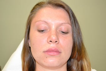 Lip Implant