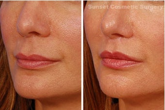 Lip lift