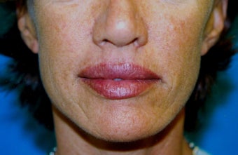 Upper and Lower Direct Lip Lift