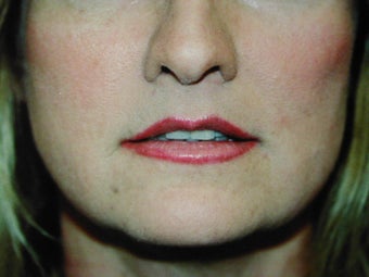 Sub Nasal Lip Lift