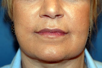 Corner of Lip Lift