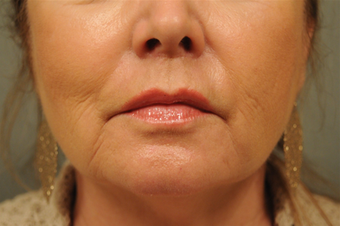 Upper lip shortening