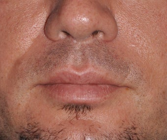 Lip Lift