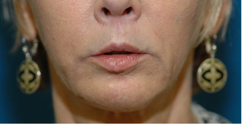 Lip lift + Chin implant + ArteFill