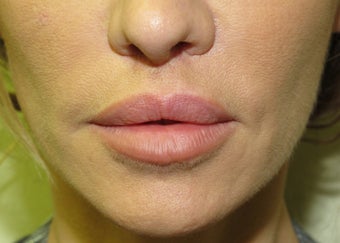lip lift