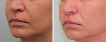 Bullhorn Lip Lift