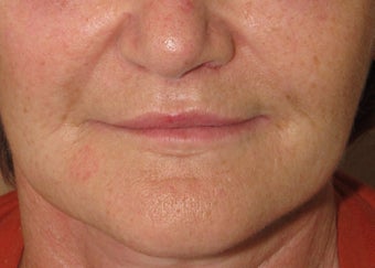 Lip lift