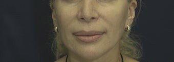 Lip Lift