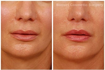Lip lift