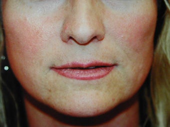 Sub Nasal Lip Lift