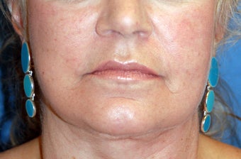 Corner of Lip Lift