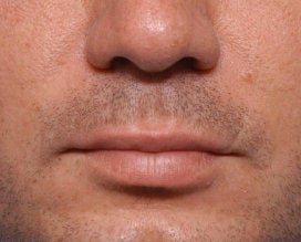 Lip Lift
